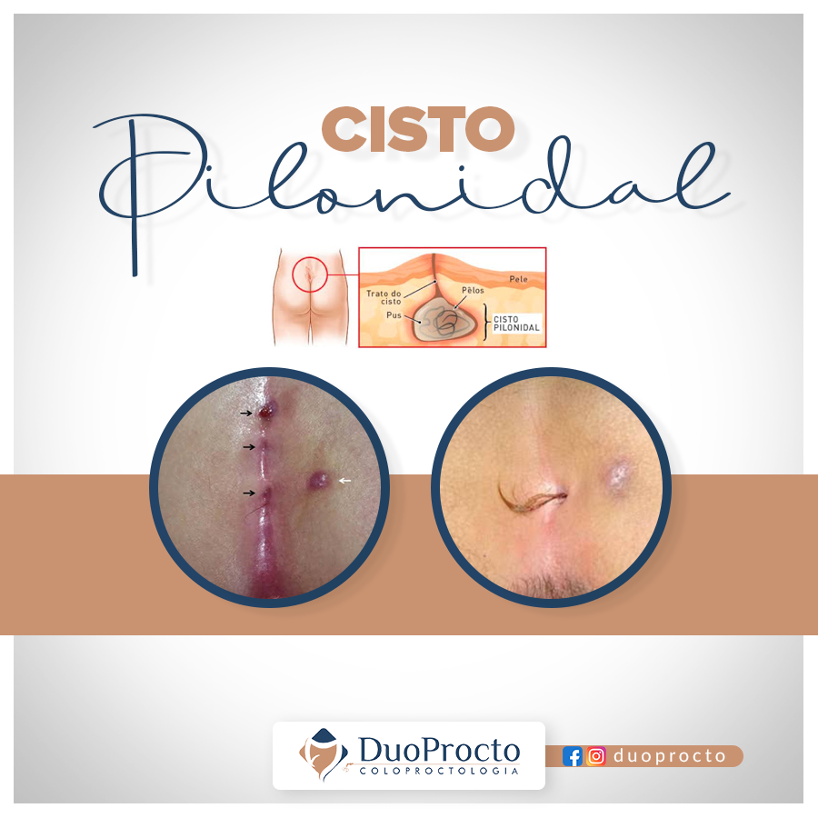 Cisto Pilonidal