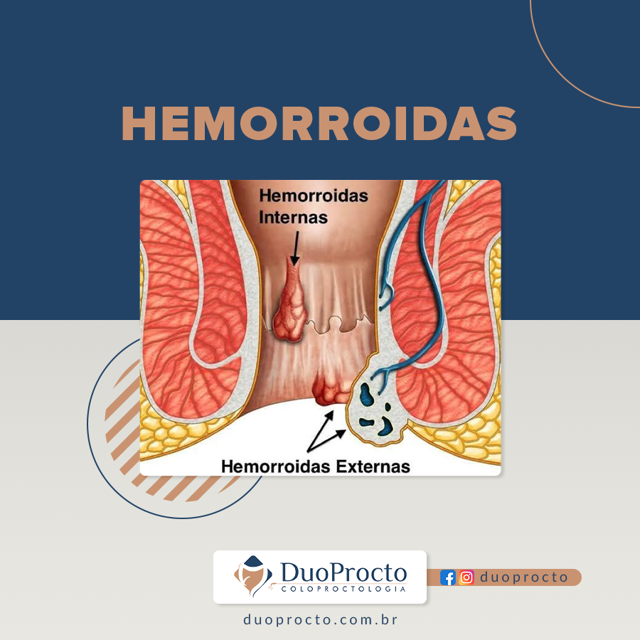 Hemorroidas: sintomas, fatores de risco, diagnóstico e tratamento