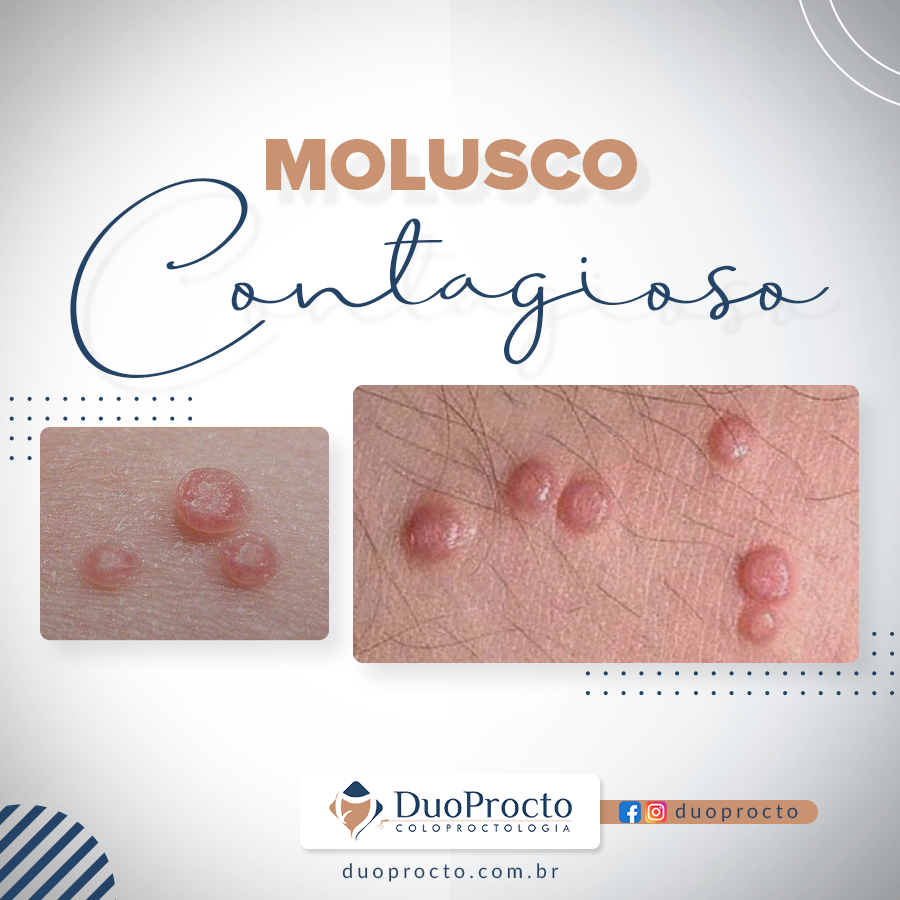 Molusco Contagioso