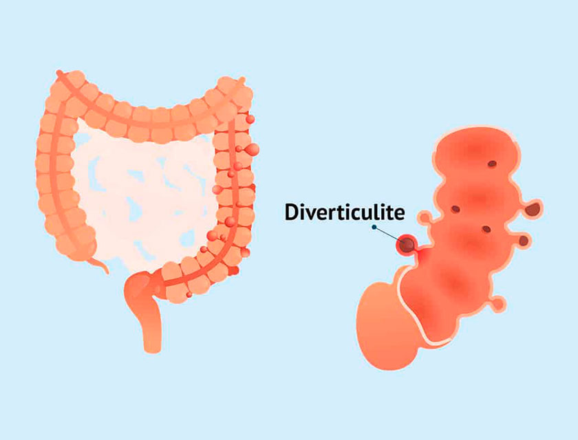 diverticulite aguda